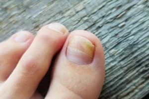 how to know if toenail fungus is dying