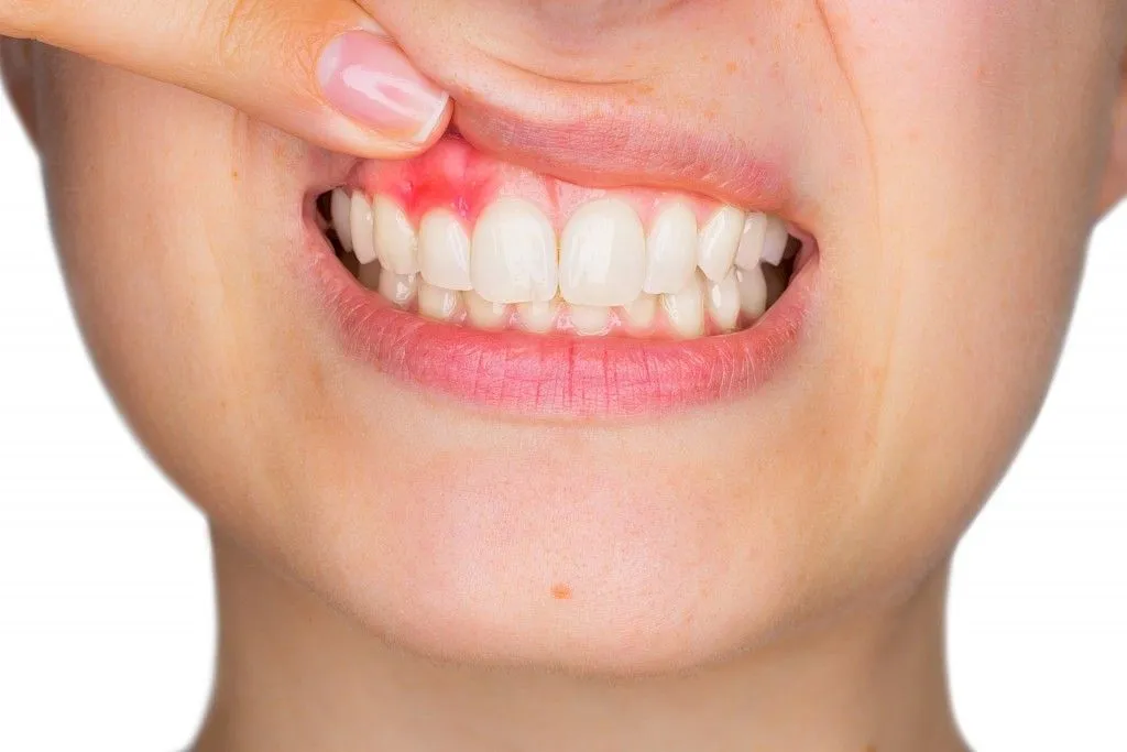 How to cure gum disease without a dentist