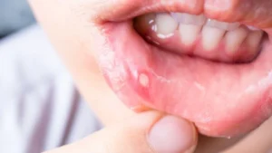 How to get rid of a canker sore in 24 hours