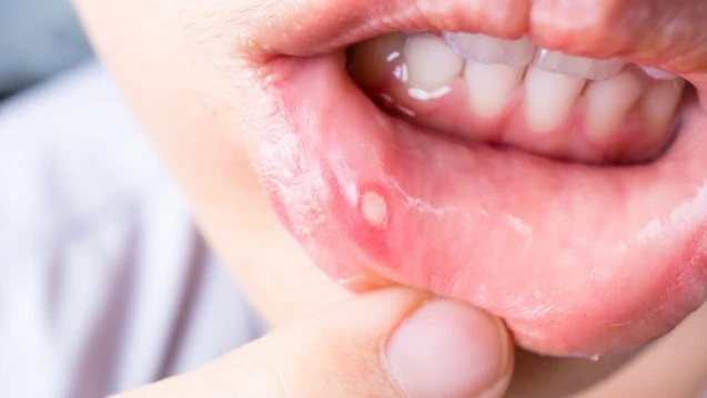 How to get rid of a canker sore in 24 hours