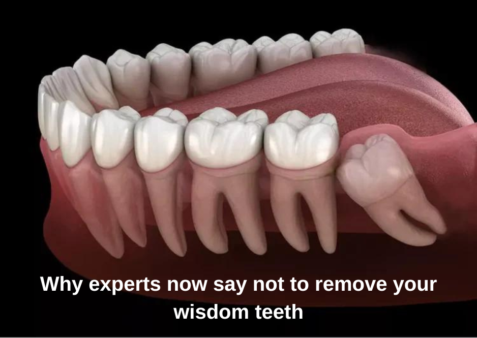 why experts now say not to remove your wisdom teeth