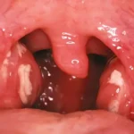 How to cure tonsillitis in 4 hours: quick relief tips